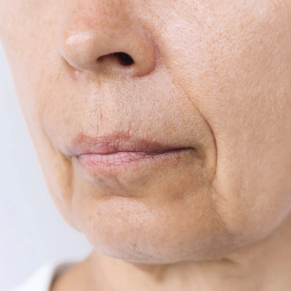 Avant - Rides Nasogénien