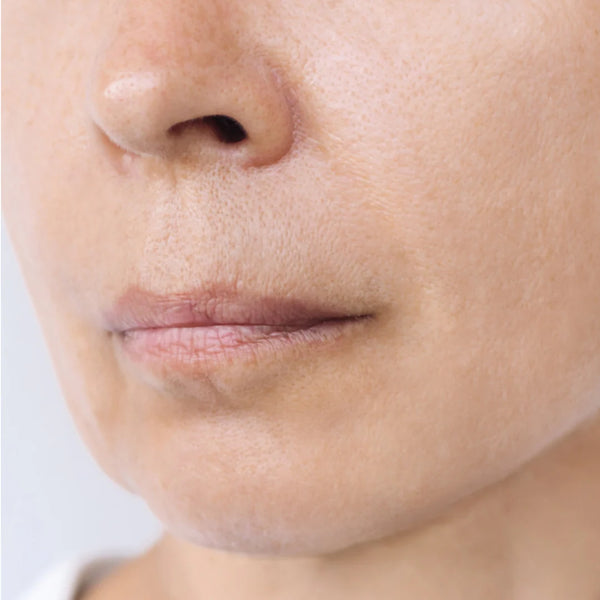 Après - Rides Nasogénien